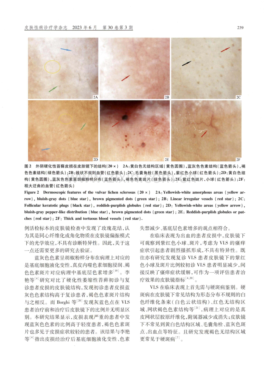 41例儿童外阴硬化性苔藓皮肤镜特征分析.pdf_第3页