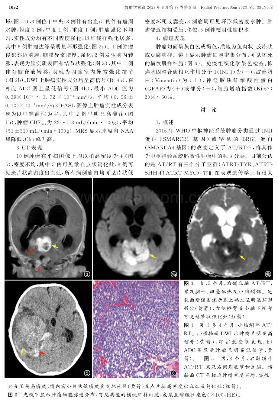 儿童颅内非典型畸胎瘤样_横纹肌样瘤的影像表现.pdf_第3页