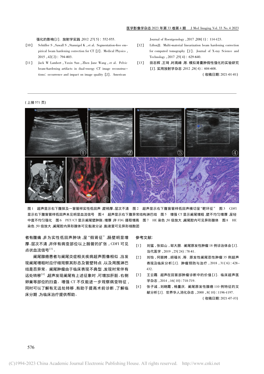 阑尾腺癌超声表现1例_刘婷.pdf_第2页