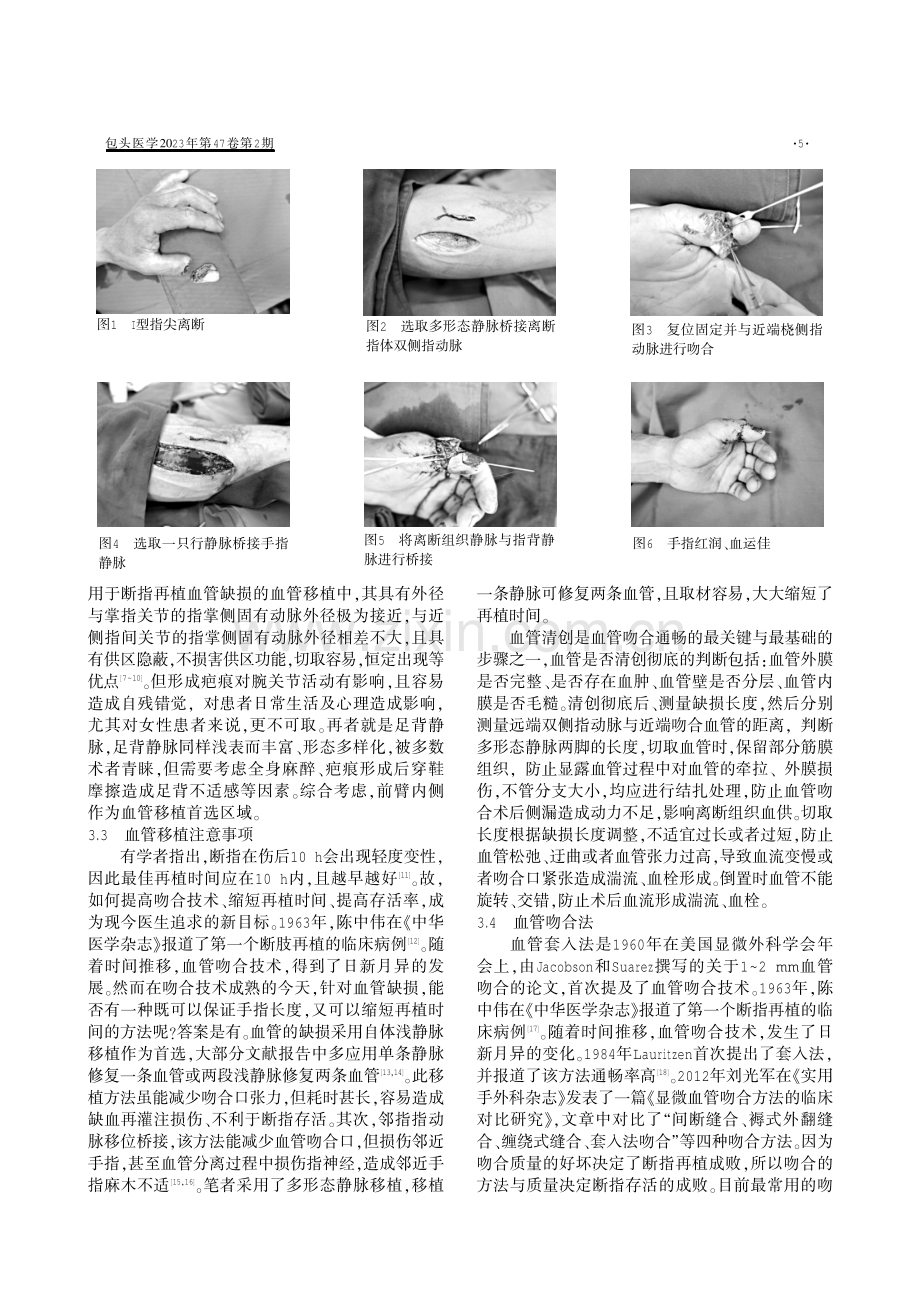 多形态静脉移植治疗手指电锯离断伤的临床研究.pdf_第2页
