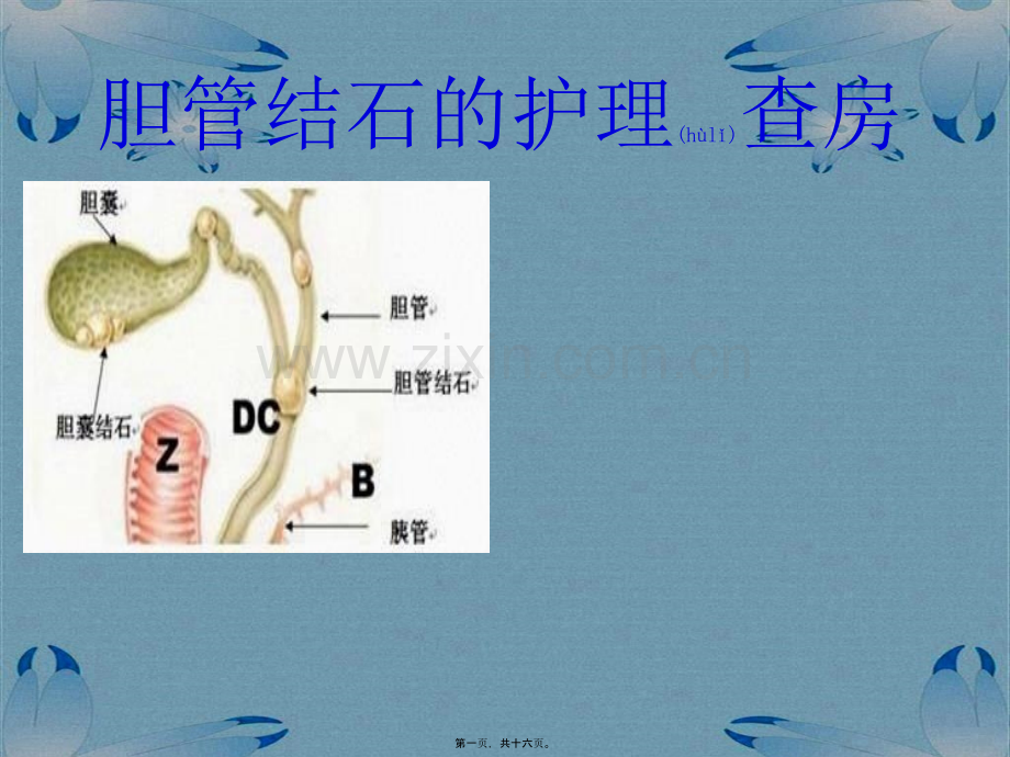 胆管结石教学查房.pptx_第1页