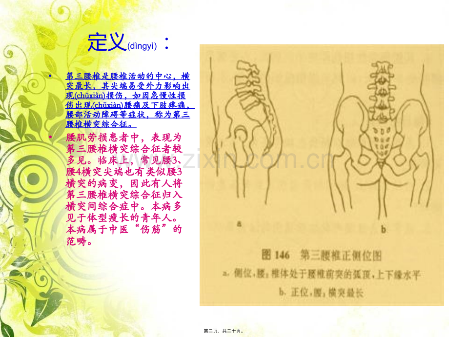 腰3横突综合症.ppt_第2页