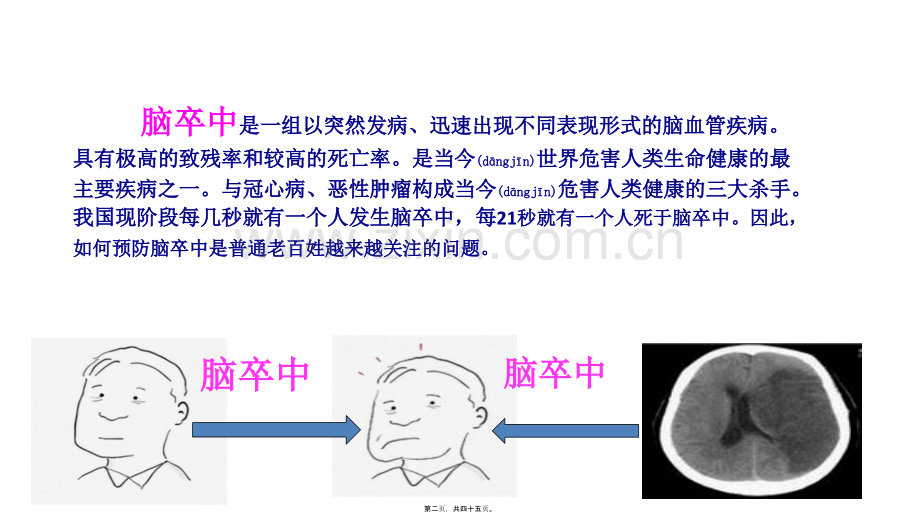脑卒中-趣味版.pptx_第2页