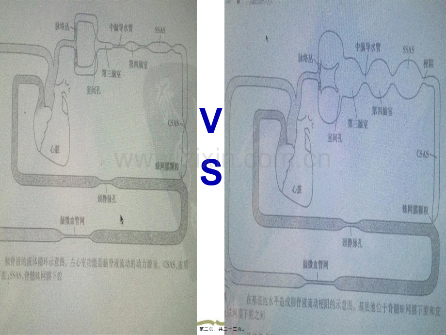 脑积水影像学特征.ppt_第2页