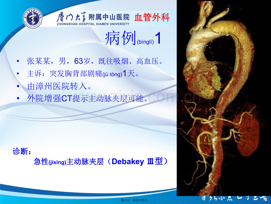 主动脉壁间血肿与穿透性溃疡.ppt_第2页