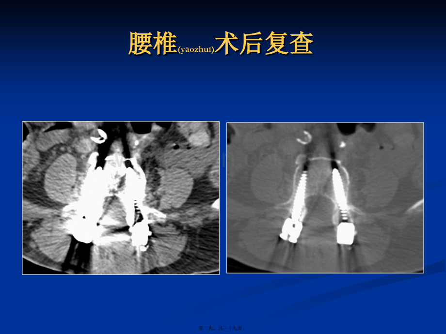 能谱CT减除骨科金属植入物.pptx_第2页