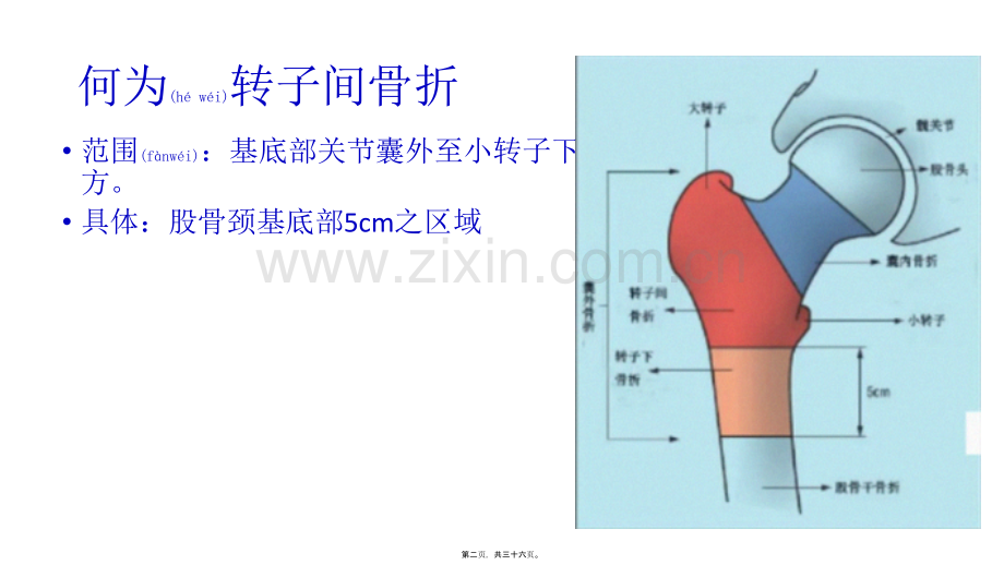 股骨粗隆间分型.pptx_第2页