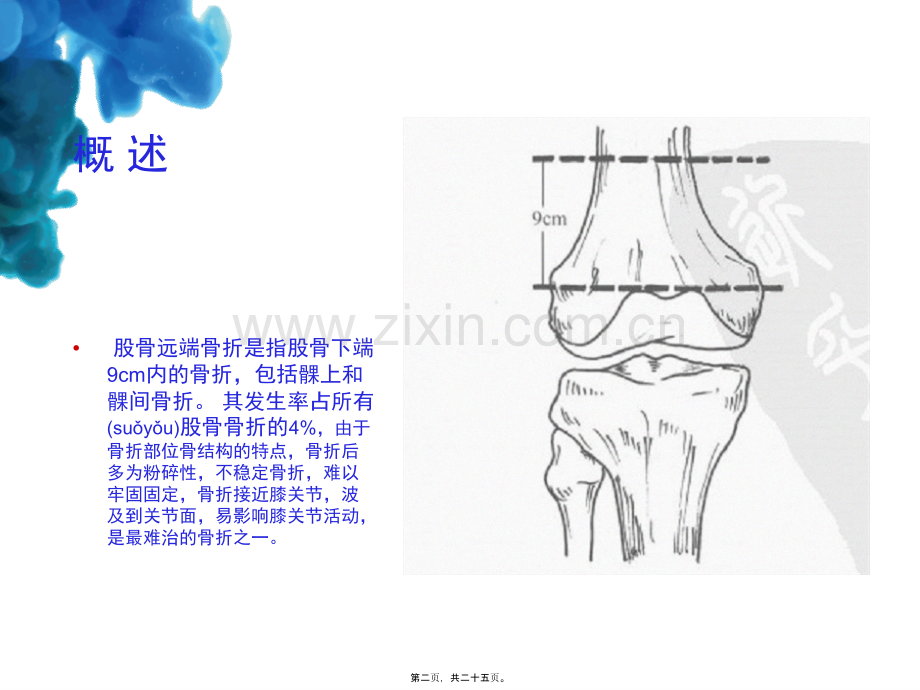 股骨远端骨折111.ppt_第2页