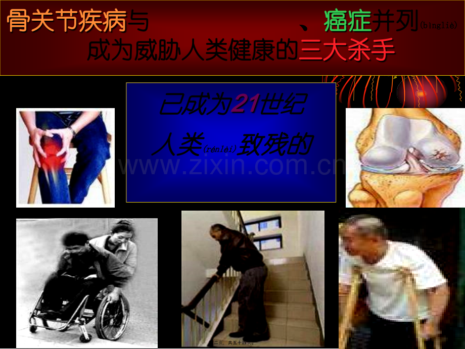 不死的癌症-骨关节病.ppt_第2页
