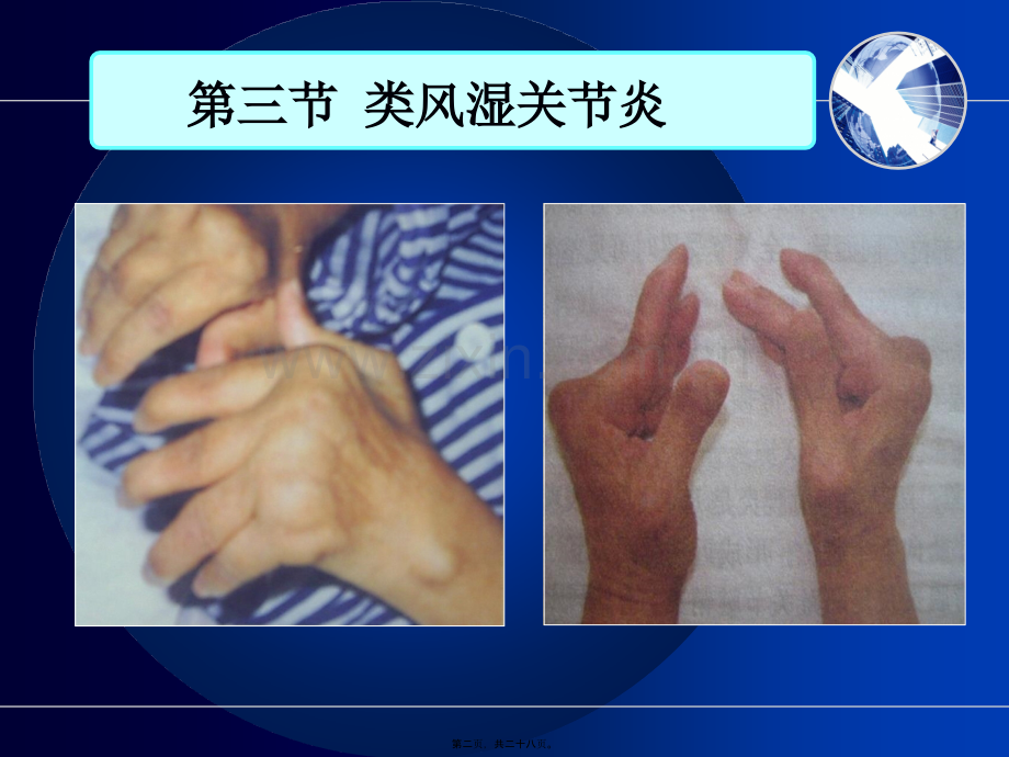 类风湿关节炎-8-2.ppt_第2页