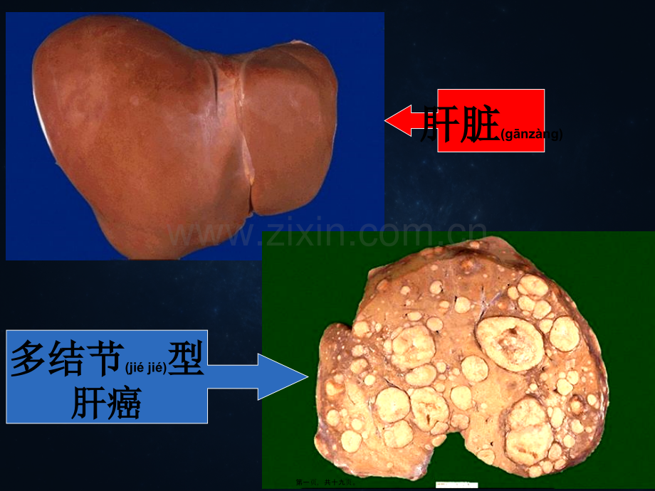 第五节---原发性肝癌.ppt_第1页
