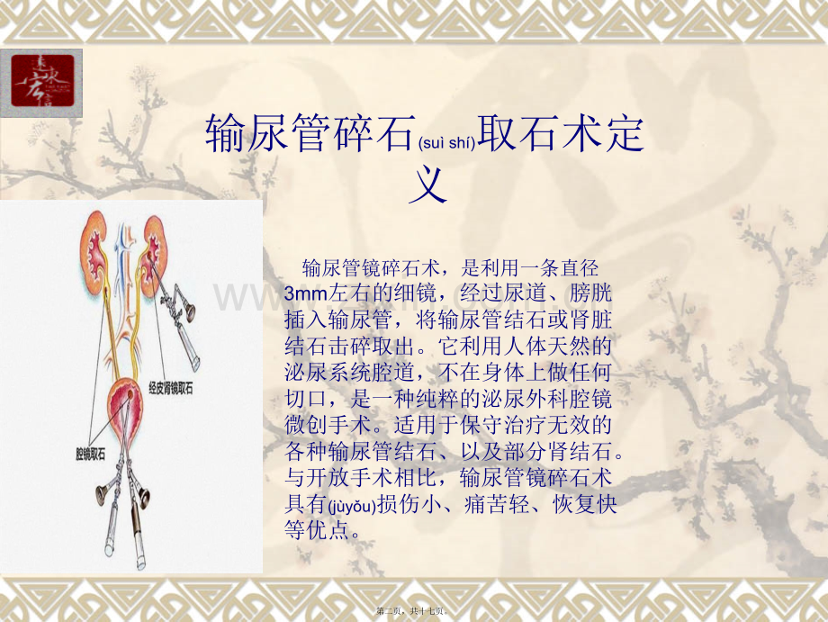 经尿道输尿管镜碎石取石术(严远平).ppt_第2页