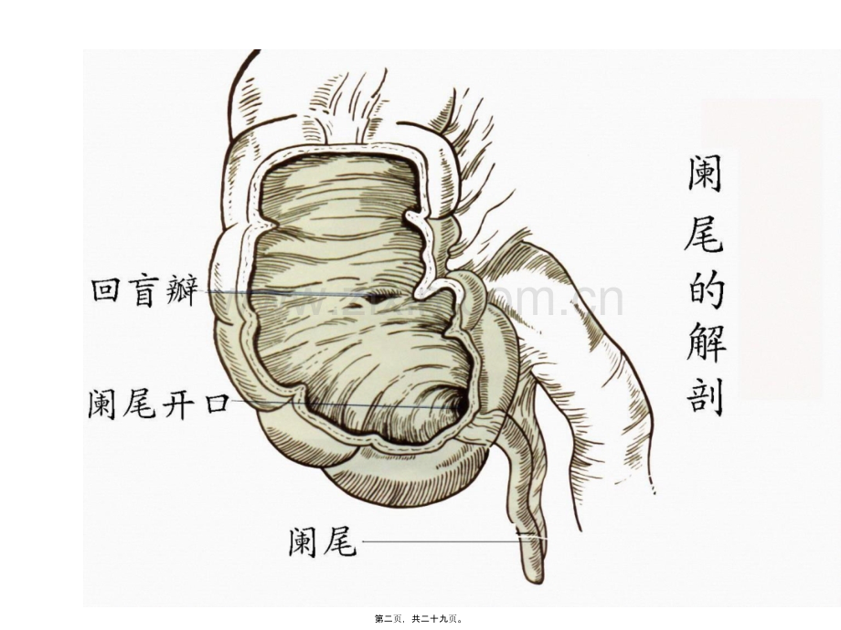 第八章-阑尾炎.ppt_第2页