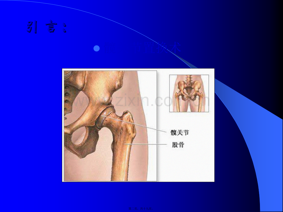 第三篇：髋关节查房.ppt_第2页