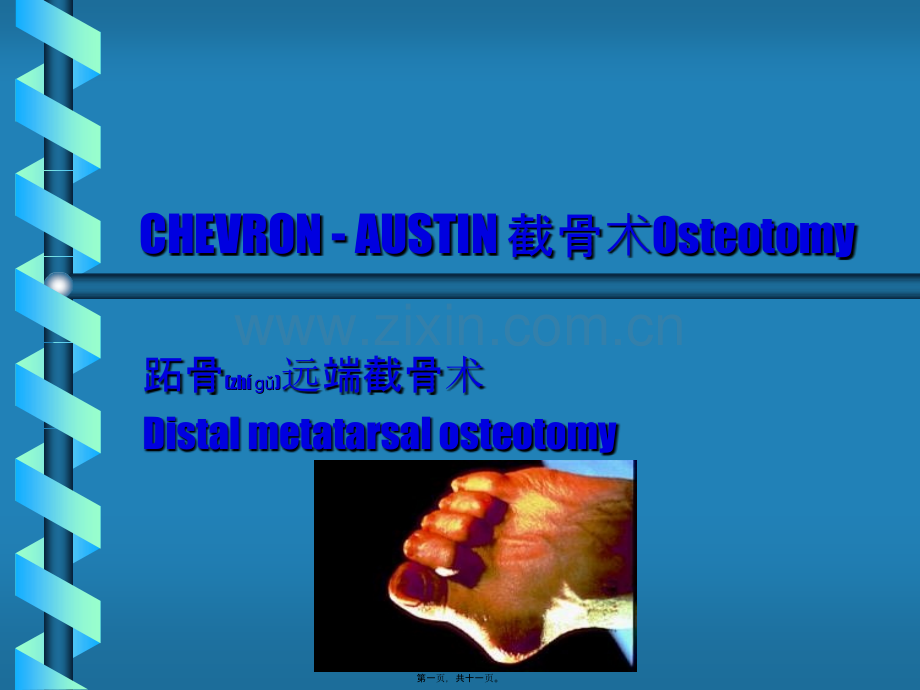 第三篇：CHEVRON---AUSTIN-踇外翻跖骨截骨术1.ppt_第1页