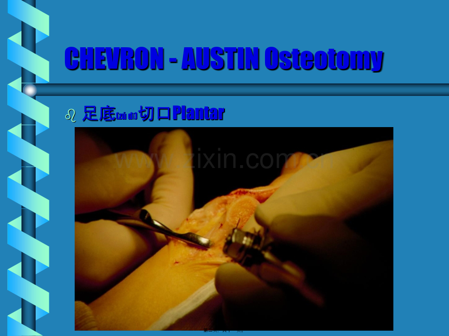 第三篇：CHEVRON---AUSTIN-踇外翻跖骨截骨术1.ppt_第2页