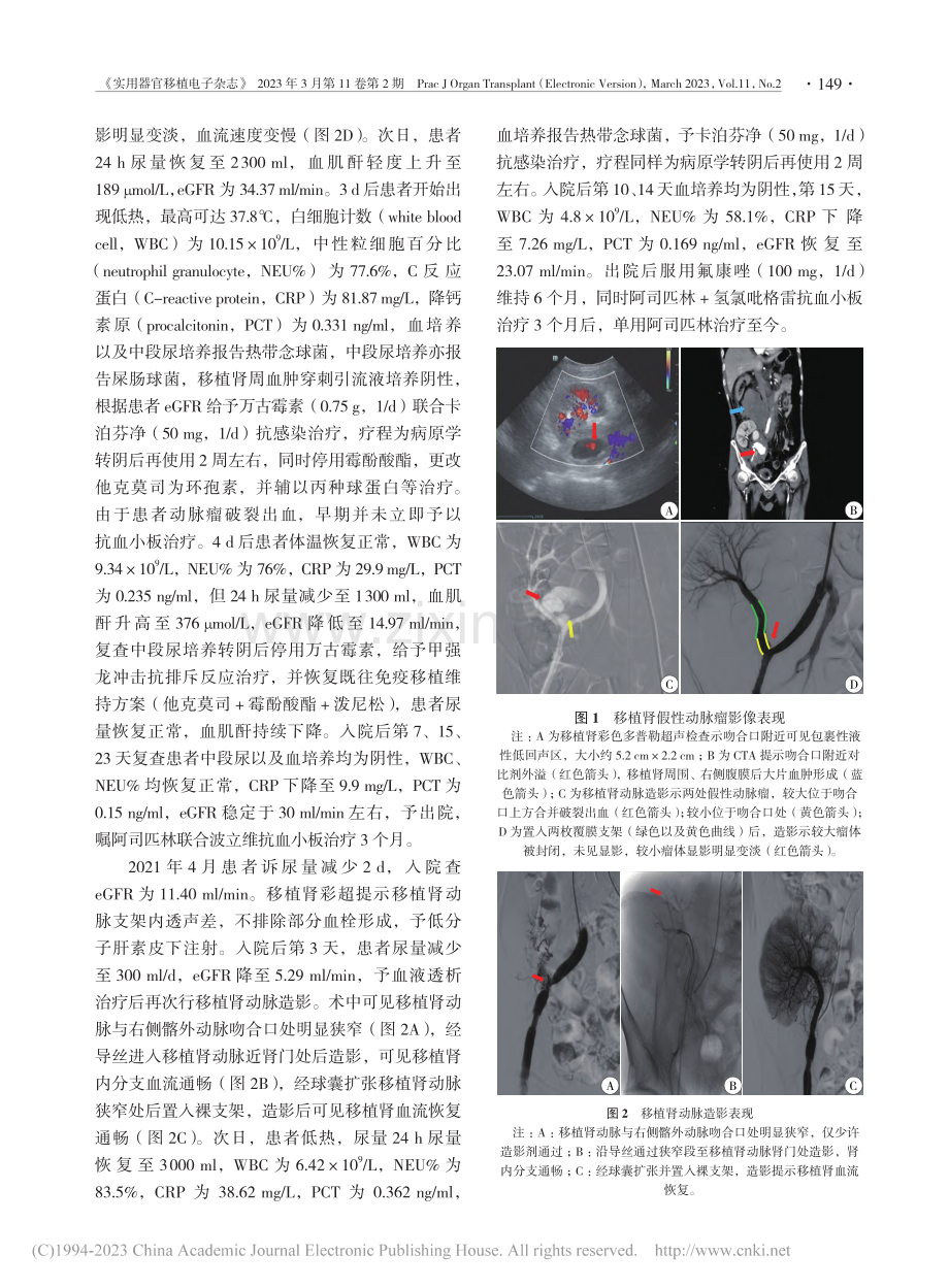 移植肾动脉假性动脉瘤合并破...入后狭窄1例报告并文献复习_刘如敏.pdf_第2页