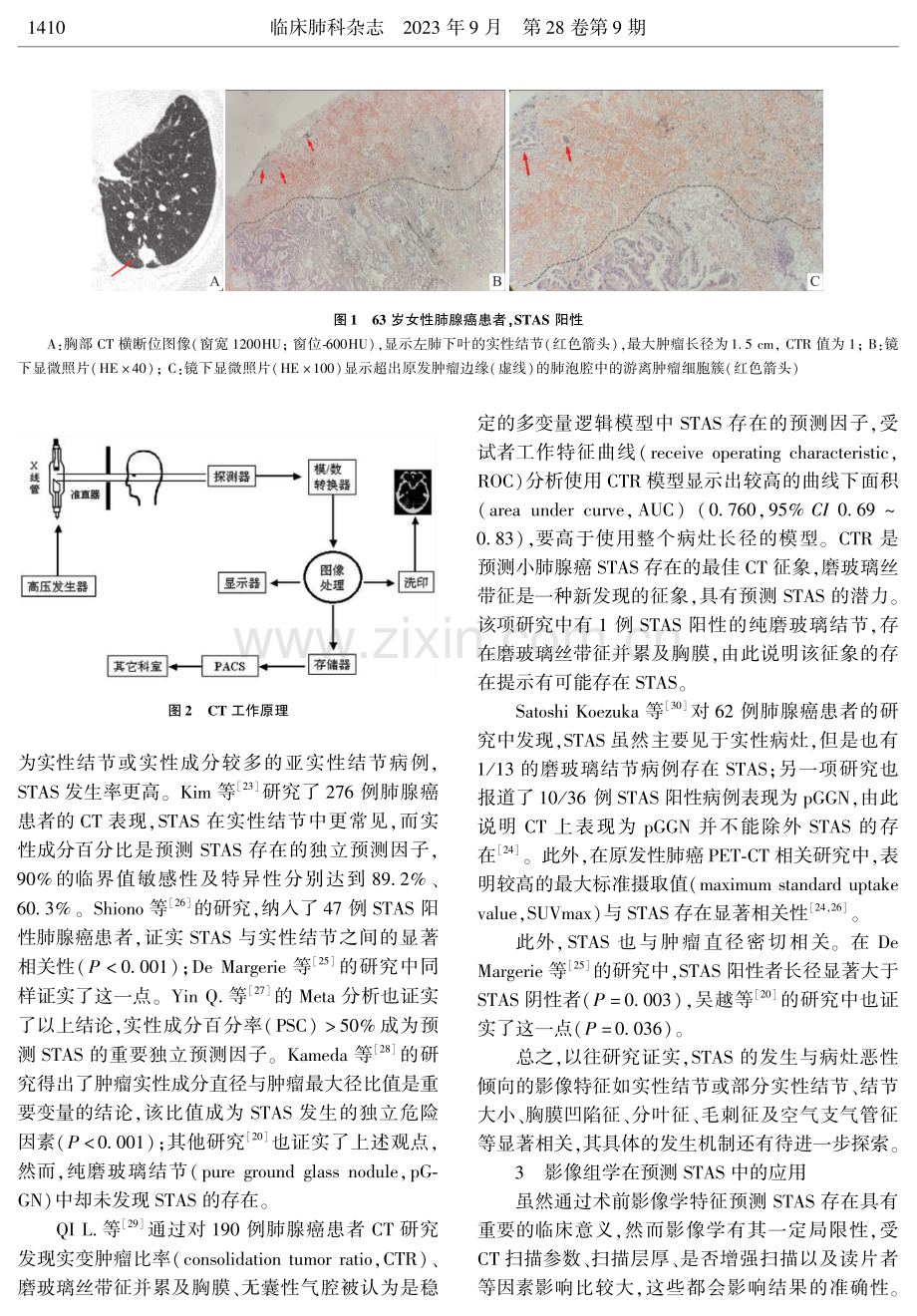 肺癌气腔播散影像学研究进展.pdf_第2页
