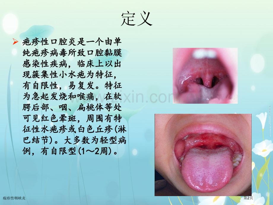 疱疹性咽峡炎.pptx_第2页