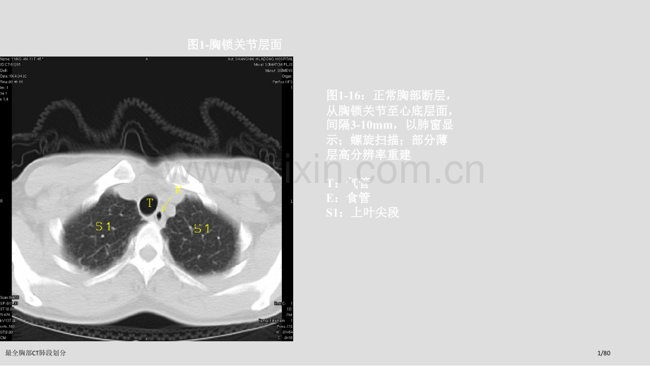 最全胸部CT肺段划分.pptx_第1页