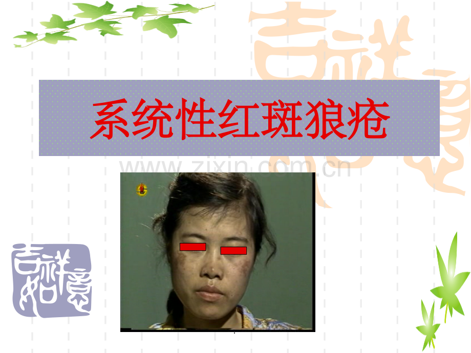 系统性红斑狼疮完整ppt课件.ppt_第1页