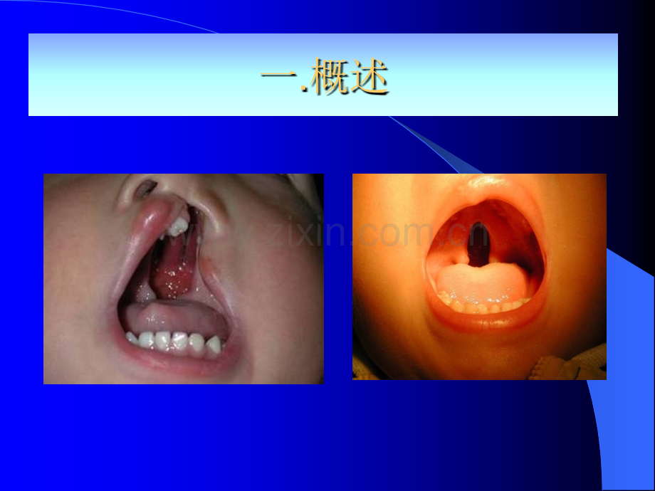 腭裂术后语音训练ppt课件.ppt_第2页