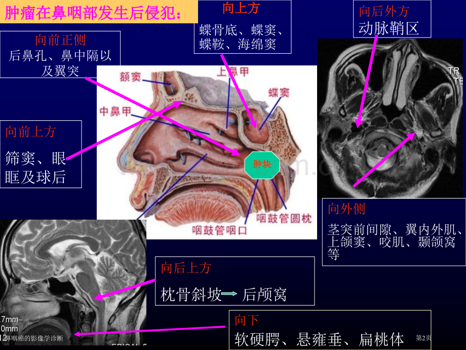 鼻咽癌的影像学诊断.pptx_第2页
