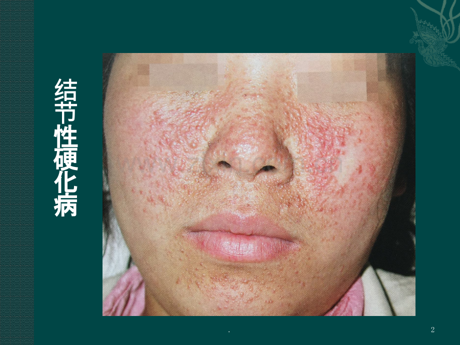 面部丘疹性皮肤病ppt课件.pptx_第2页