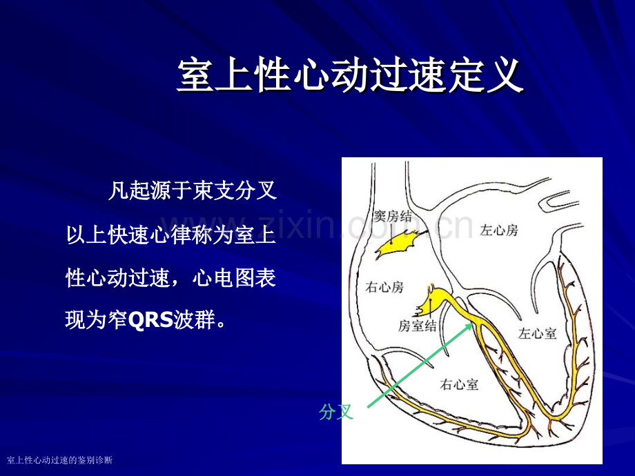 室上性心动过速的鉴别诊断.pptx_第2页