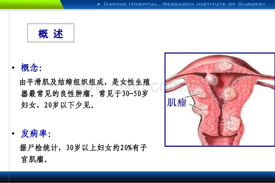 子宫肌瘤课件优质PPT课件.ppt_第2页
