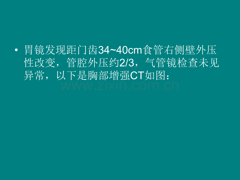 纵隔型肺癌.ppt_第2页