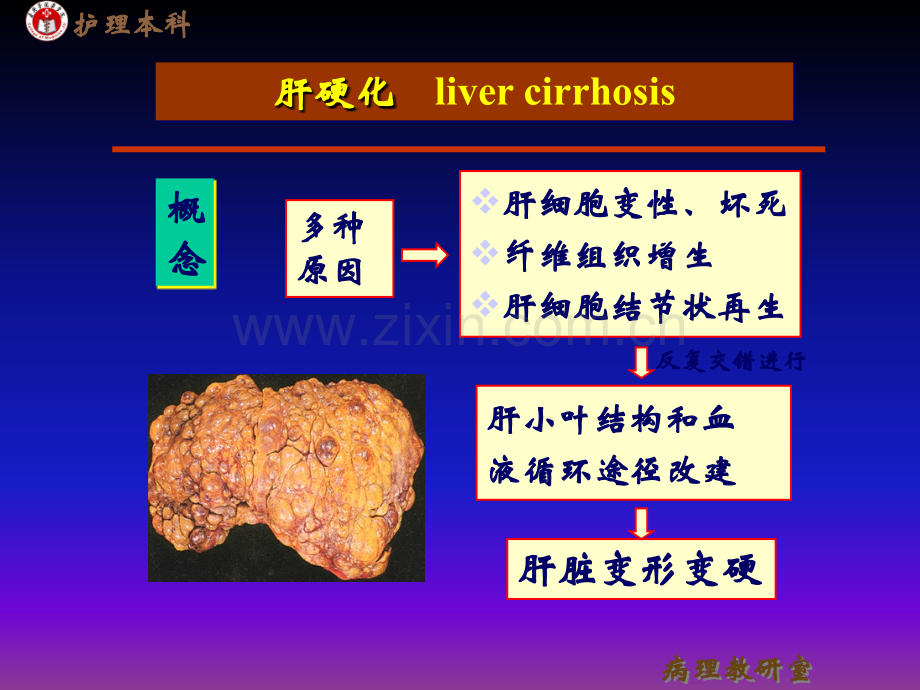 病理学肝硬化肝癌ppt课件.ppt_第1页