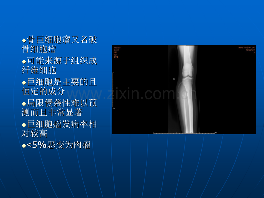 骨巨细胞瘤的手术方式选择ppt课件.pptx_第2页