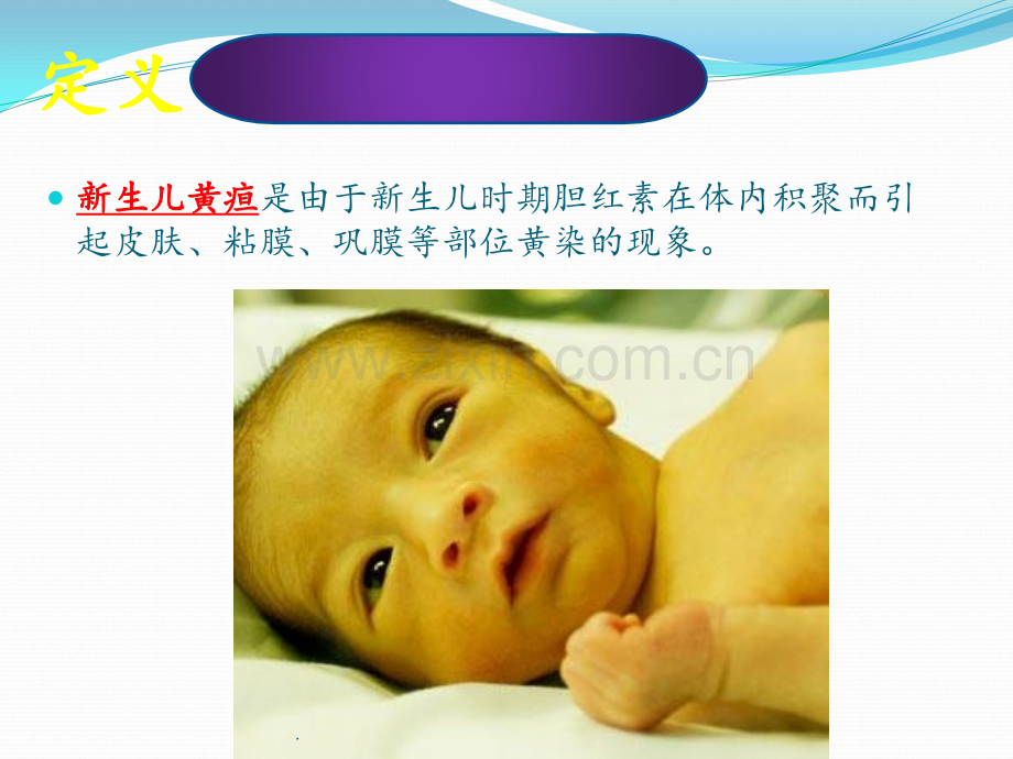 新生儿黄疸护理.pptx_第2页