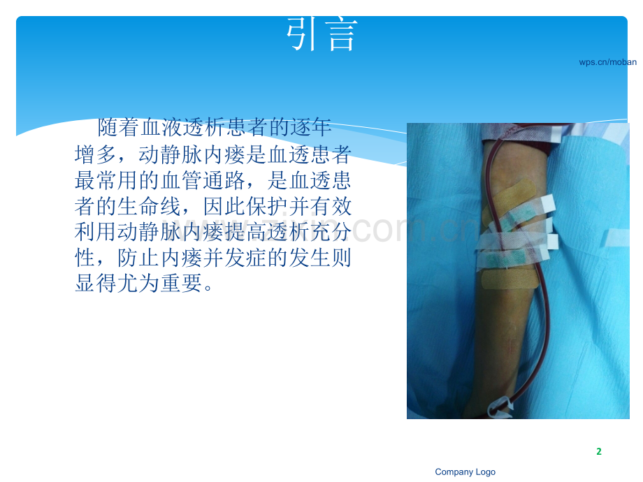 动静脉内瘘的穿刺与护理ppt课件.ppt_第2页