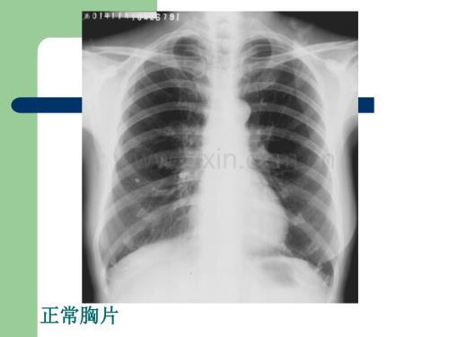 肺部正常和X线异常表现.ppt