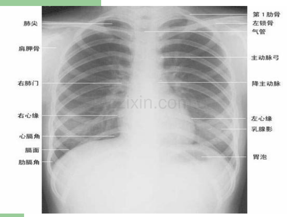 肺部正常和X线异常表现.ppt_第2页