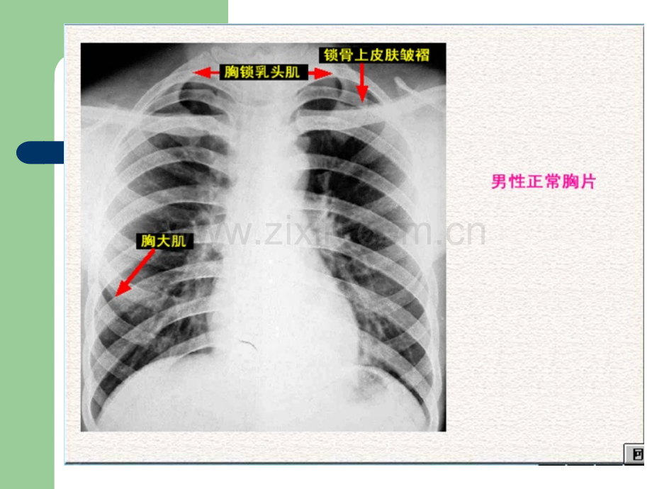 肺部正常和X线异常表现.ppt_第3页