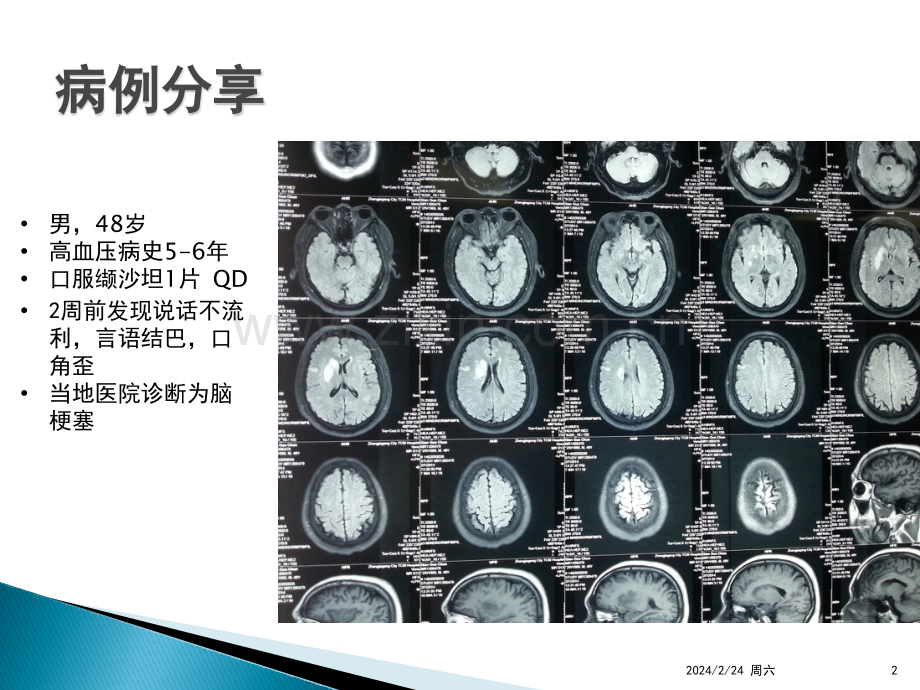 神经外科患者围手术期出血及凝血功能障碍的处理PPT课件.pptx_第2页