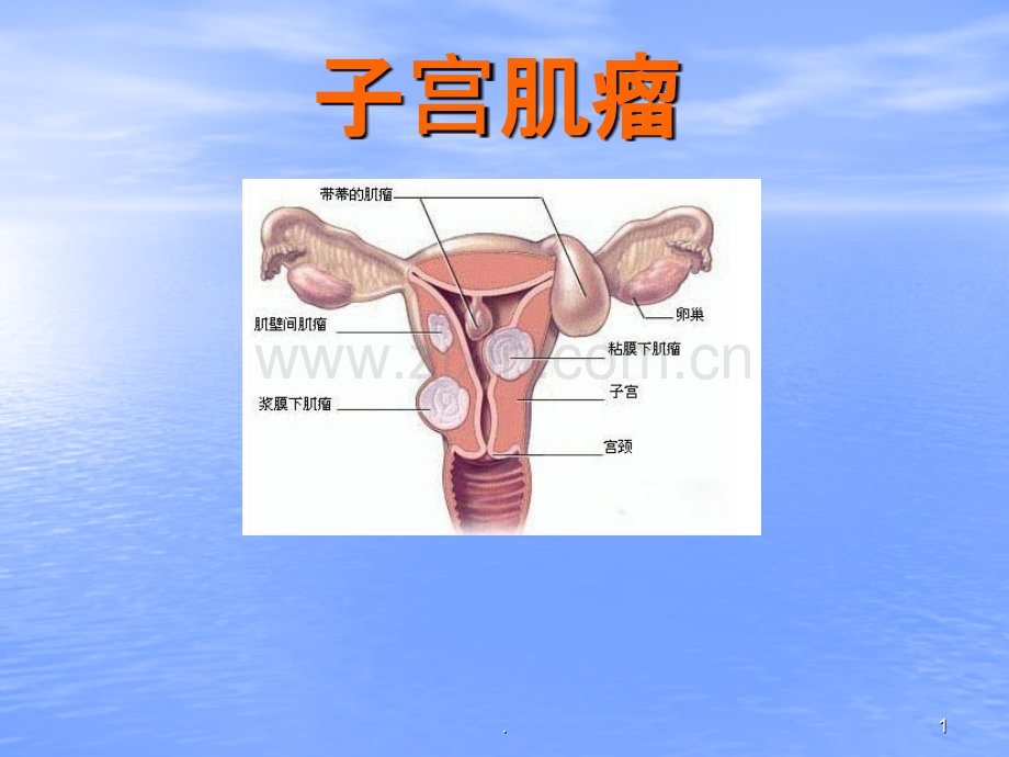 子宫肌瘤PPT演示课件.ppt_第1页