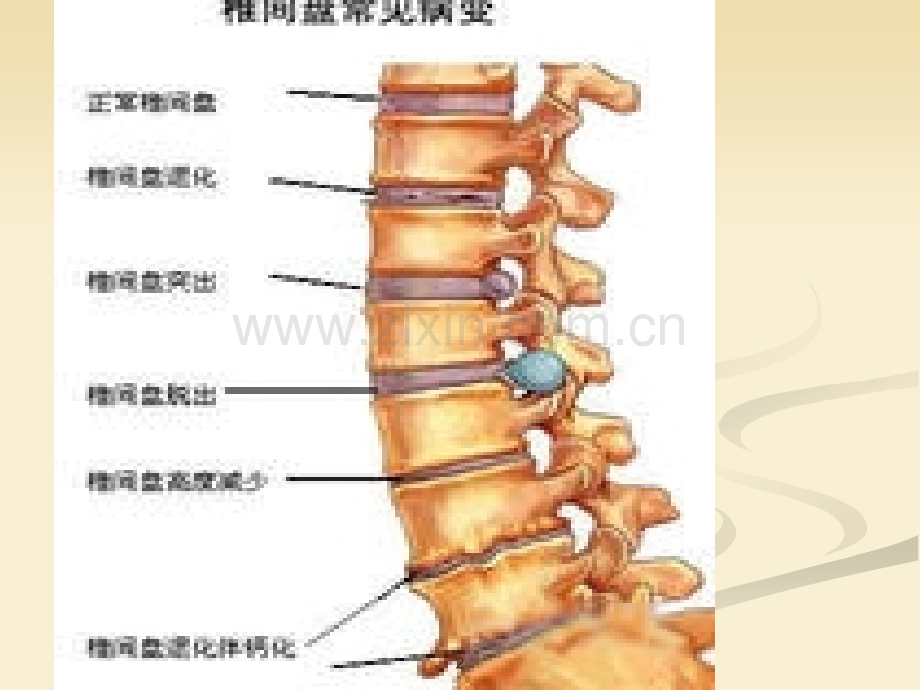 学会怎样看腰椎间盘突出CT和MRI磁共振PPT课件.ppt_第2页