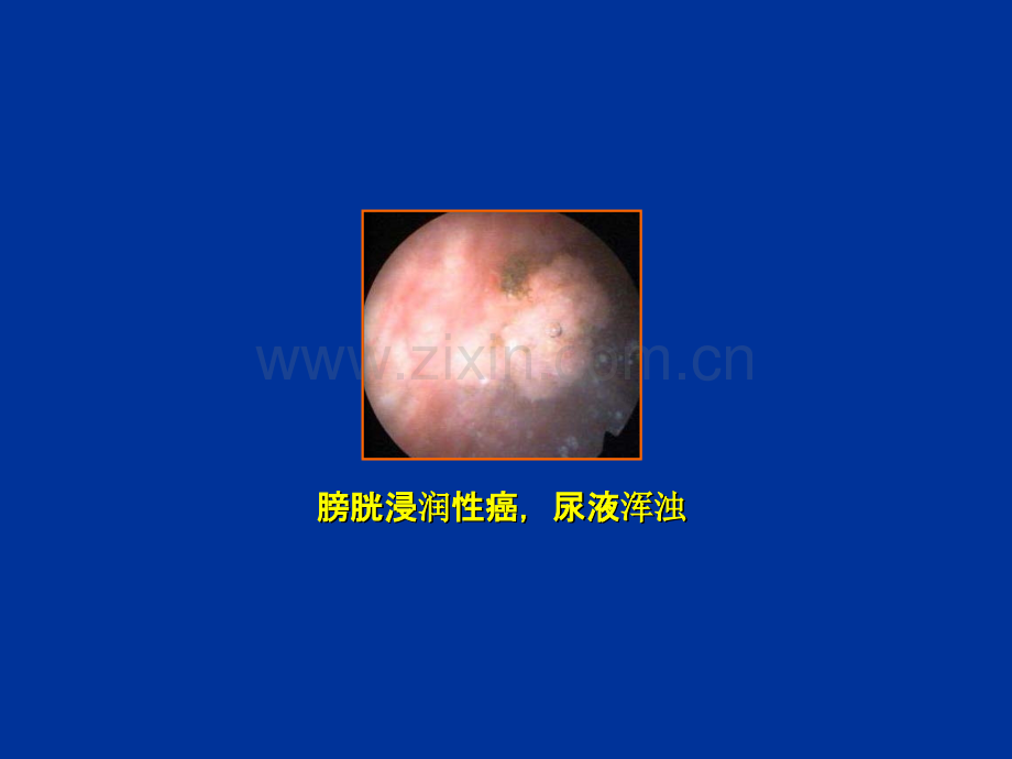 膀胱镜图谱.ppt_第1页