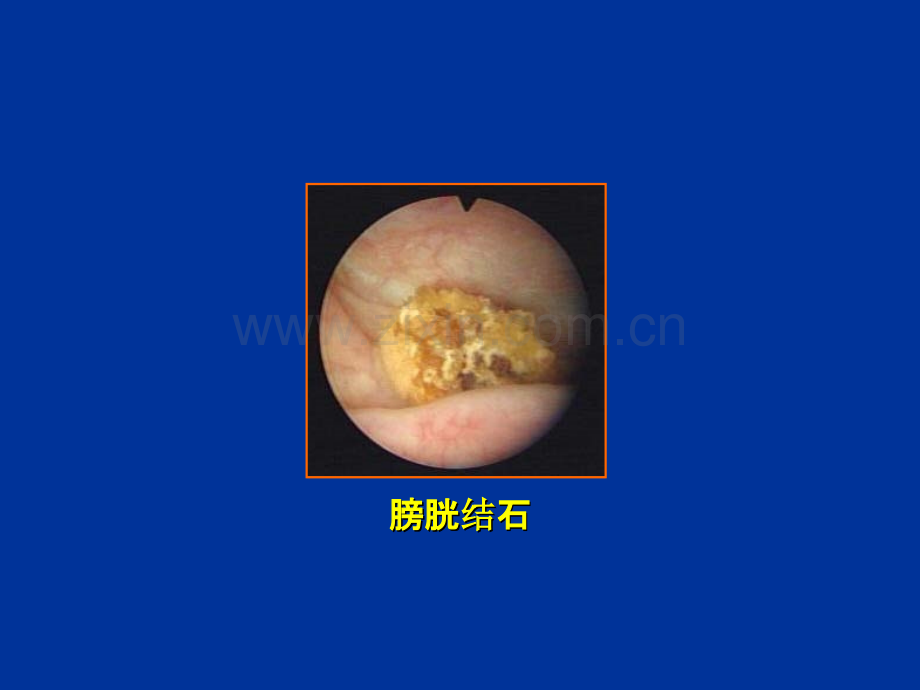 膀胱镜图谱.ppt_第2页