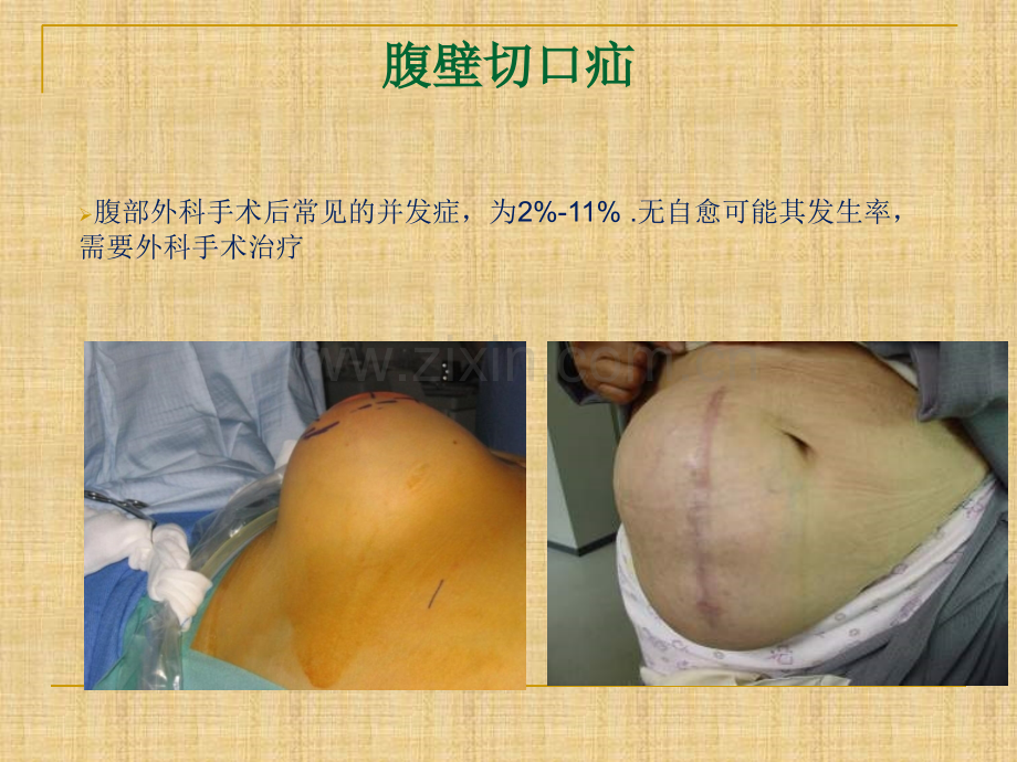 腹壁疝的治疗.ppt_第2页