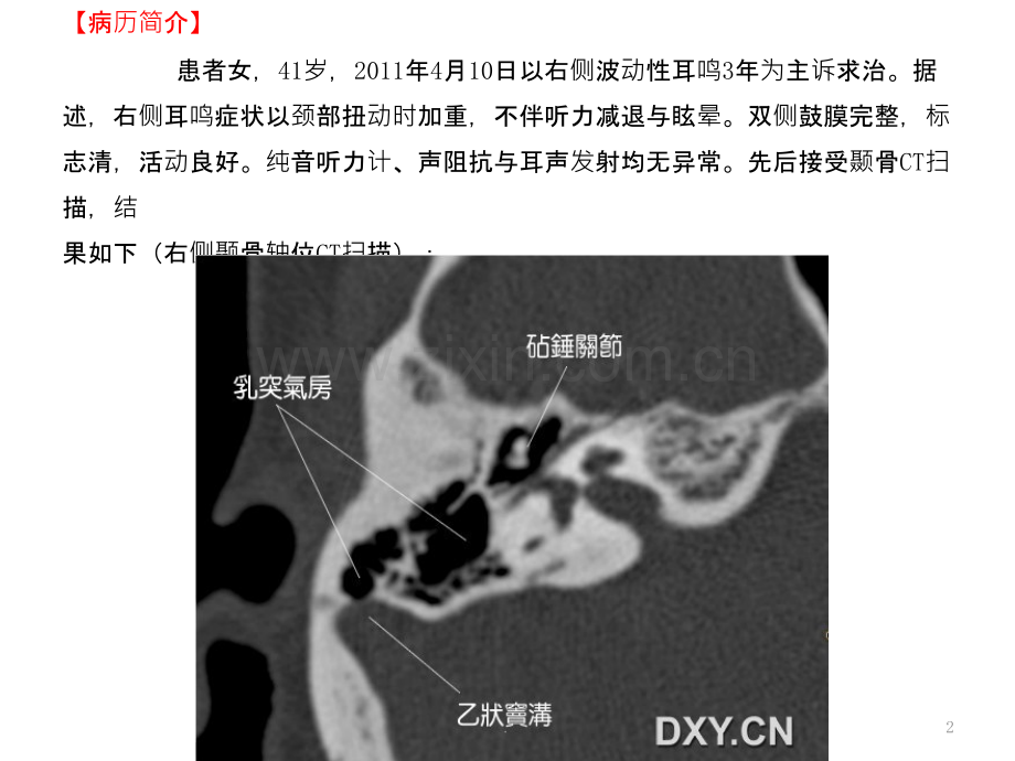 耳鸣与乙状窦憩室.ppt_第2页