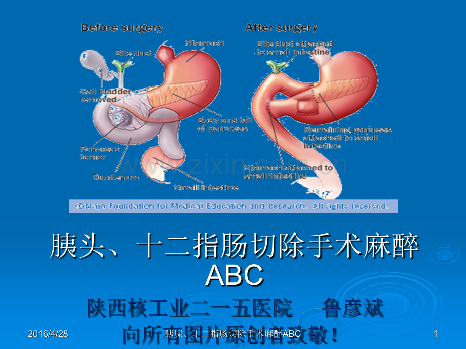 胰腺、十二指肠手术麻醉ABCppt课件.pptx_第1页