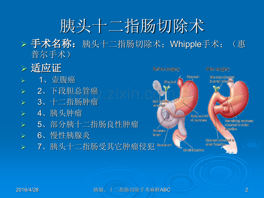 胰腺、十二指肠手术麻醉ABCppt课件.pptx_第2页