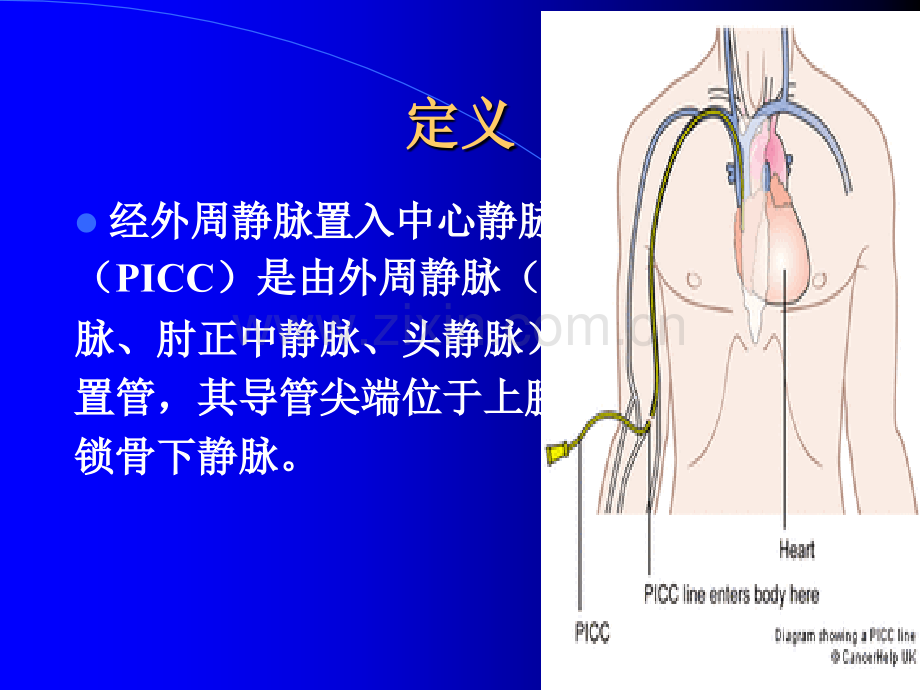PICC置管后的居家护理18209.ppt_第2页