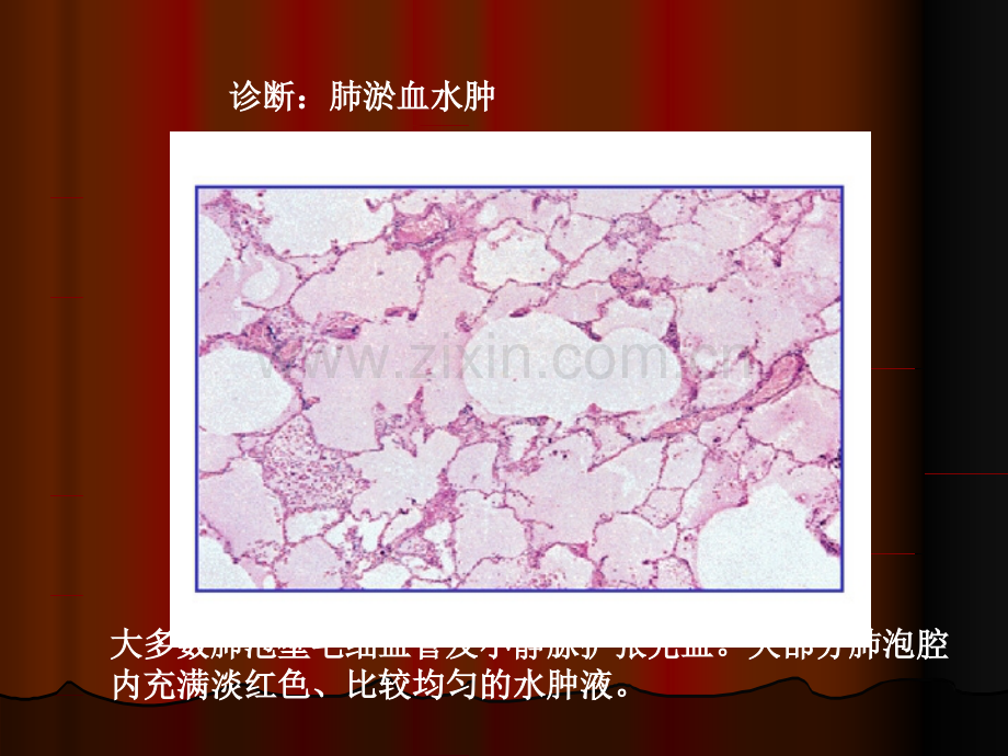 病理切片-肺.ppt_第2页