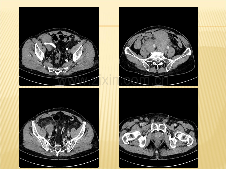 腹膜后脂肪肉瘤影像学表现与鉴别诊断ppt课件.ppt_第3页
